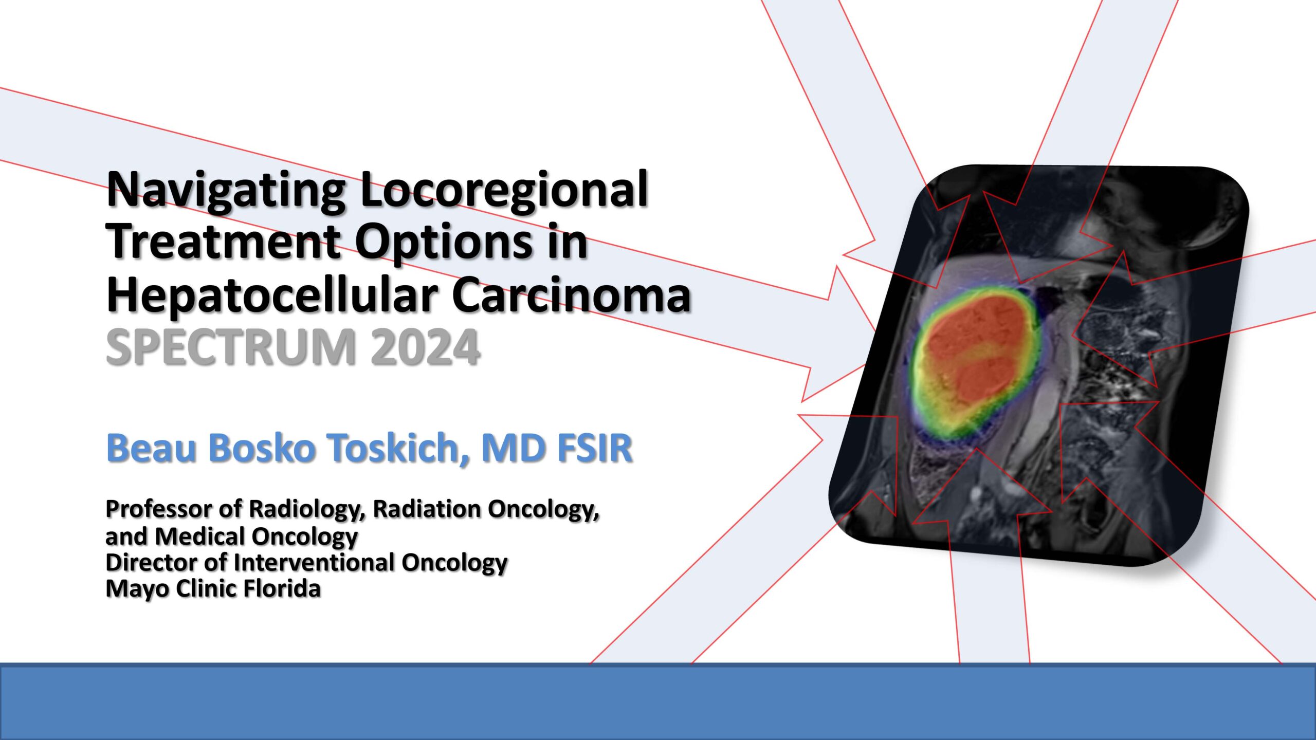Navigating locoregional treatment options in HCC